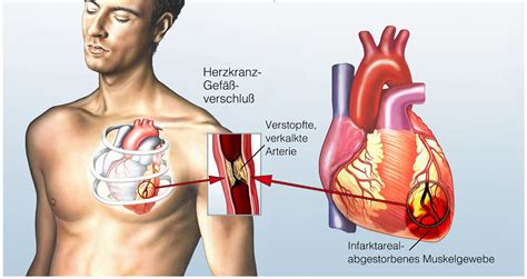 angina pectoris van az koronare herzkrankheit Kindle Editon