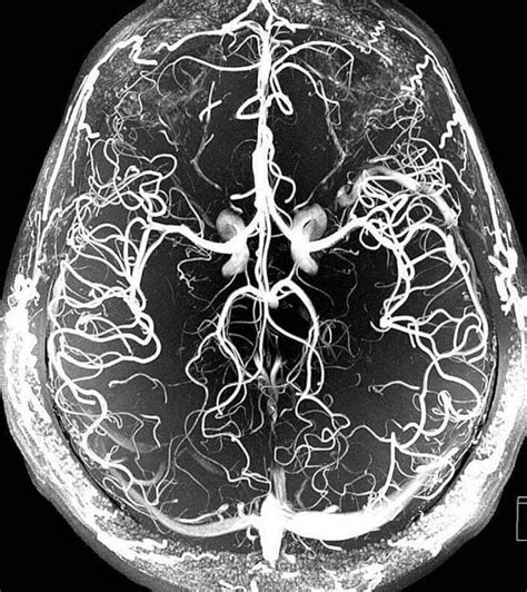 angiografia cerebral