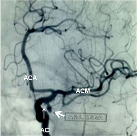 angiografia cerebral aneurisma