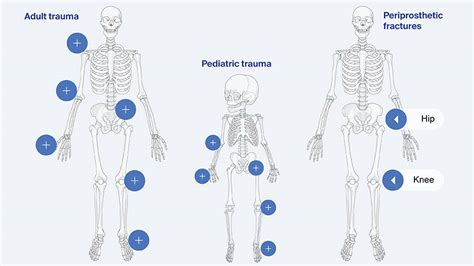 ao reference surgery