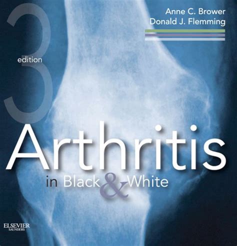 arthritis in black and white arthritis in black and white Reader