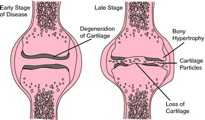 arthroclasia