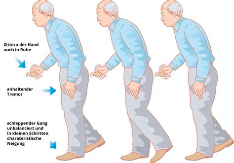 auf dem schlappseil skizzen parkinson Doc