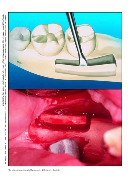 autogenous bone grafts in oral and Reader