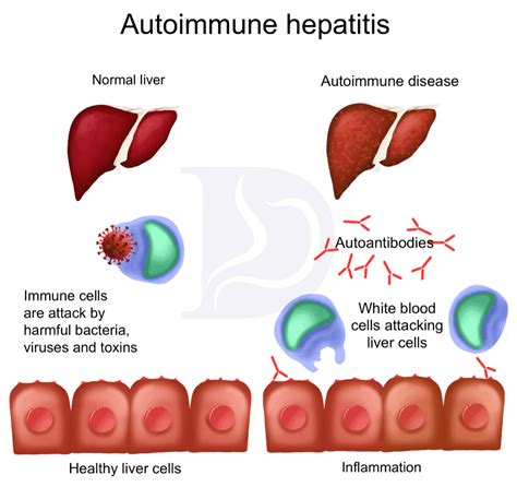 autoimmune hepatitis autoimmune hepatitis Doc
