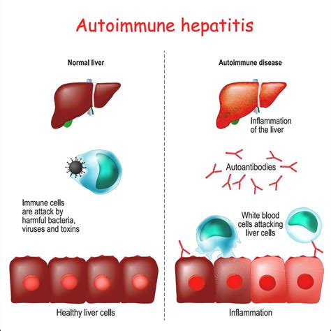 autoimmune hepatitis autoimmune hepatitis Doc