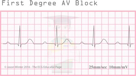 av block type 1