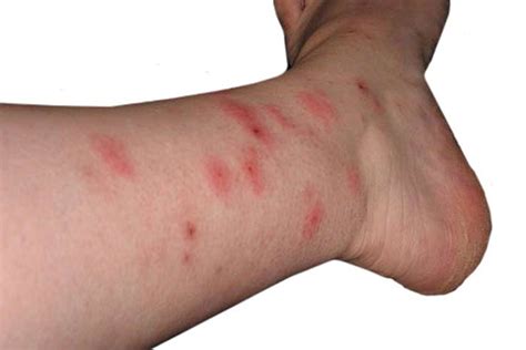 bed bug bites take how long to appear