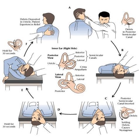 benign paroxysmal positional vertigo treatment medication