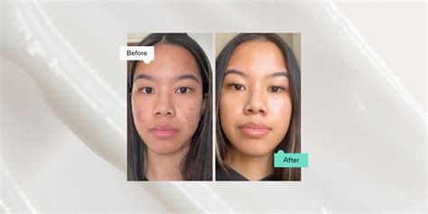 benzoyl peroxide before or after sunscreen