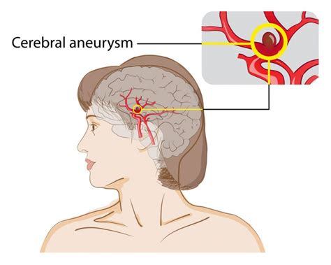 ber die aneurysmen hirnarterien lebert PDF