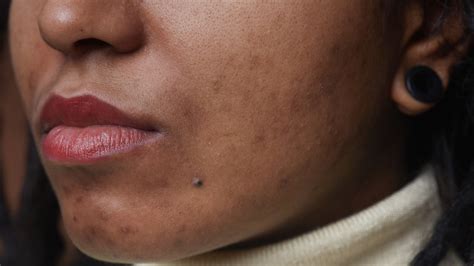 black acne on skin