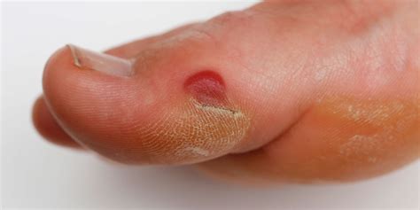 blister from shoes on toe