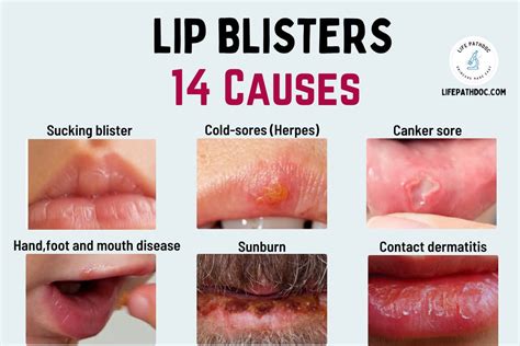 blister on lip not cold sore