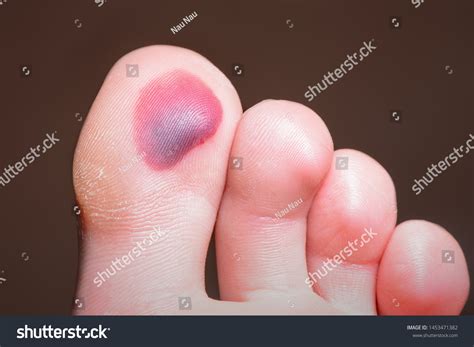 blood blister on bottom of foot