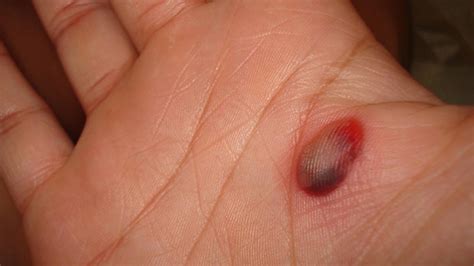 blood blister or melanoma