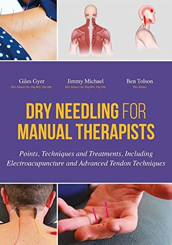 book and pdf dry needling manual therapists electroacupuncture Kindle Editon