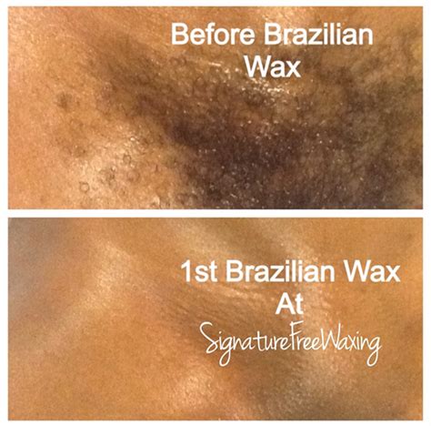 brazilian wax before and after