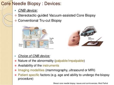 breast core biopsy breast core biopsy Reader