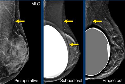 breast implant imaging PDF