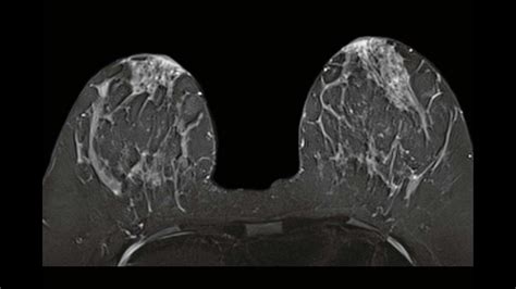 breast mri breast mri Reader