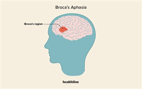 broca afasia