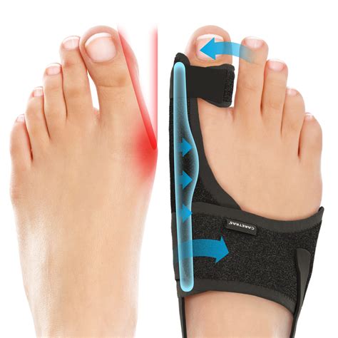 bunion corrector