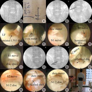 calcified disk manual guide pdf Epub