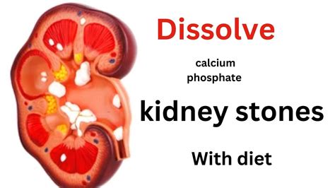 calcium phosphate kidney stones