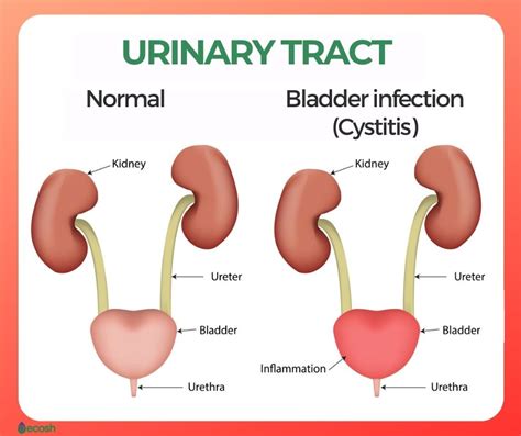 can a bladder infection cause bloating