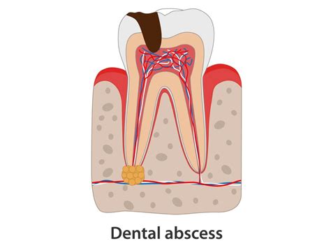 can an abscess go away on its own