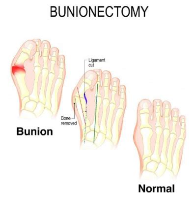 can getting bunion surgery disqualify you from the air force