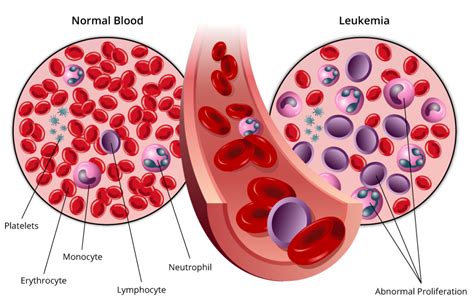 can leukemia spread to other organs