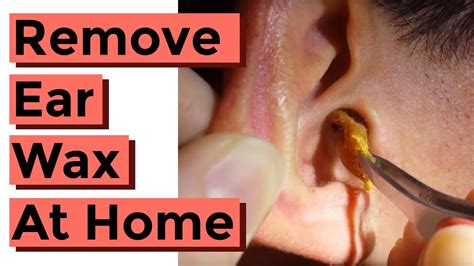 can you remove impacted ear wax at home