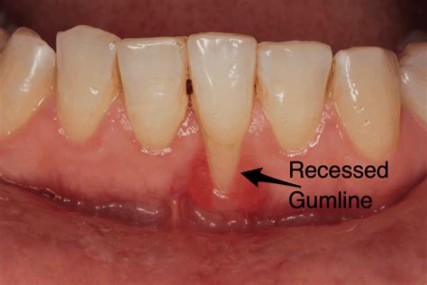 can zyn cause receding gums