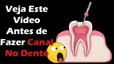 canal no dente