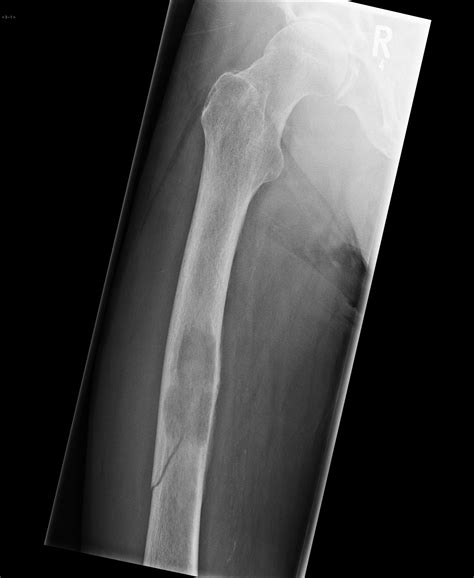 cancer bone metastases pathological fractures PDF