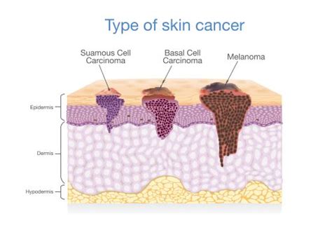 cancer of the skin cancer of the skin Kindle Editon