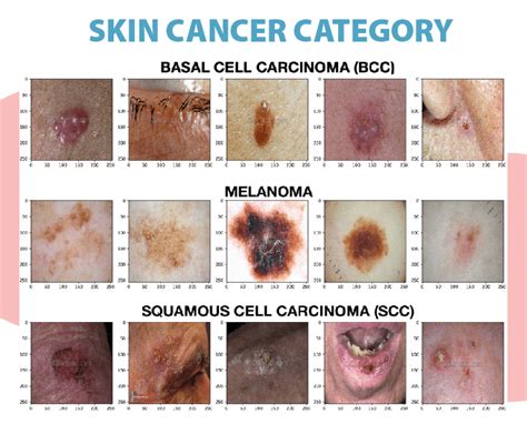 cancer of the skin cancer of the skin Kindle Editon