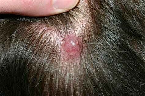 cancer pimples on head