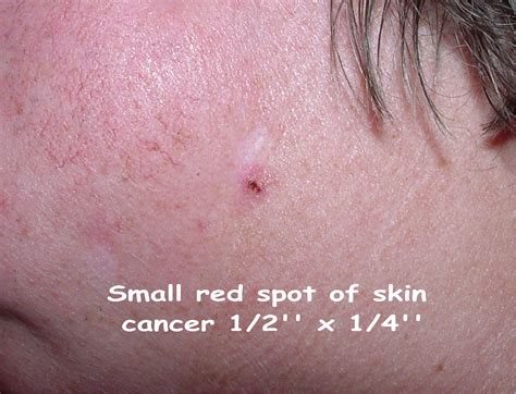 cancer spots on skin