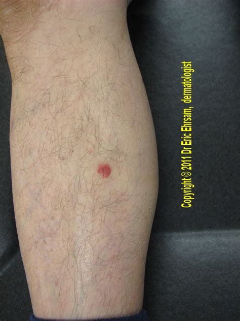 cancerous growth on leg