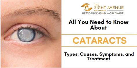 cataracts back to sight cataracts back to sight PDF