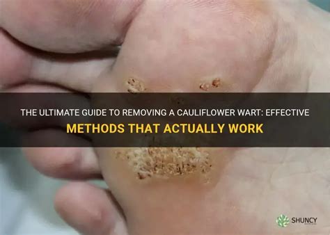 cauliflower warts manual guide Reader