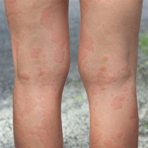 causes of sudden rash all over body