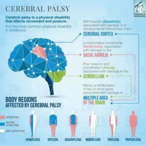 cerebral palsy not necessary maxi move Epub