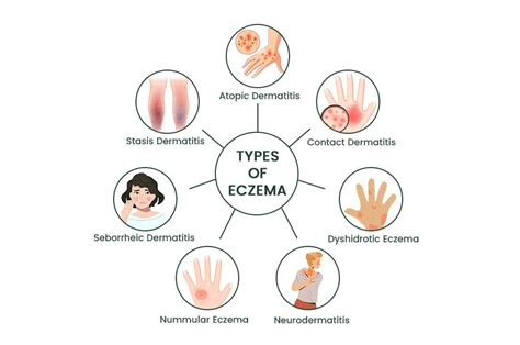 Chart Different Types Of Eczema