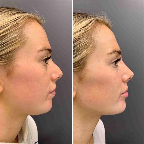 chin filler cost