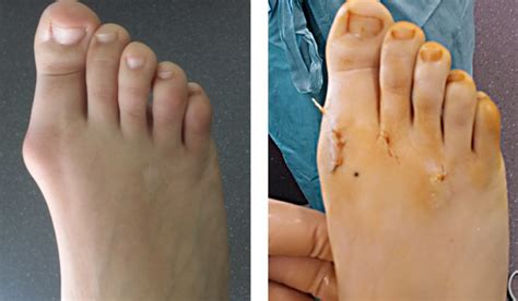 chirurgie mini invasive percutan e du pied Reader