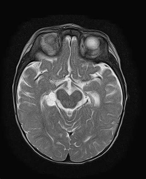 choroidal cyst manual guide Doc